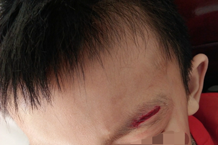 撞伤眉毛症状图