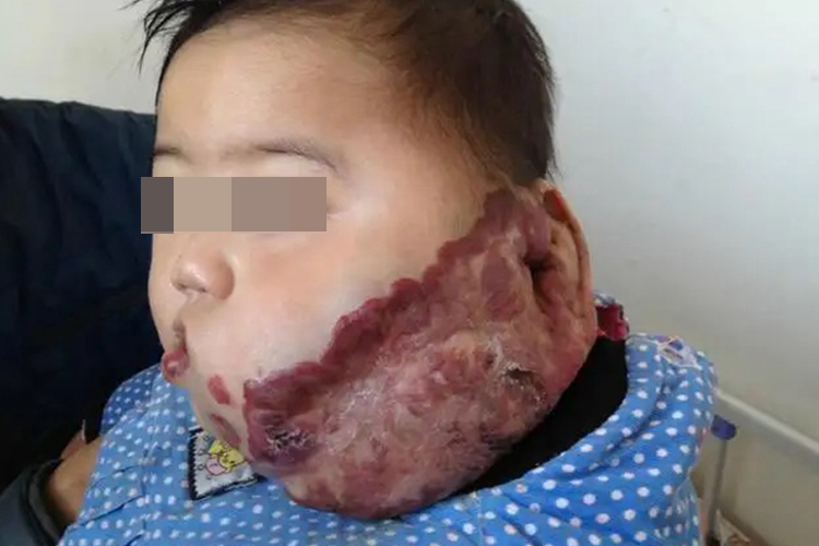 海绵状血管瘤图