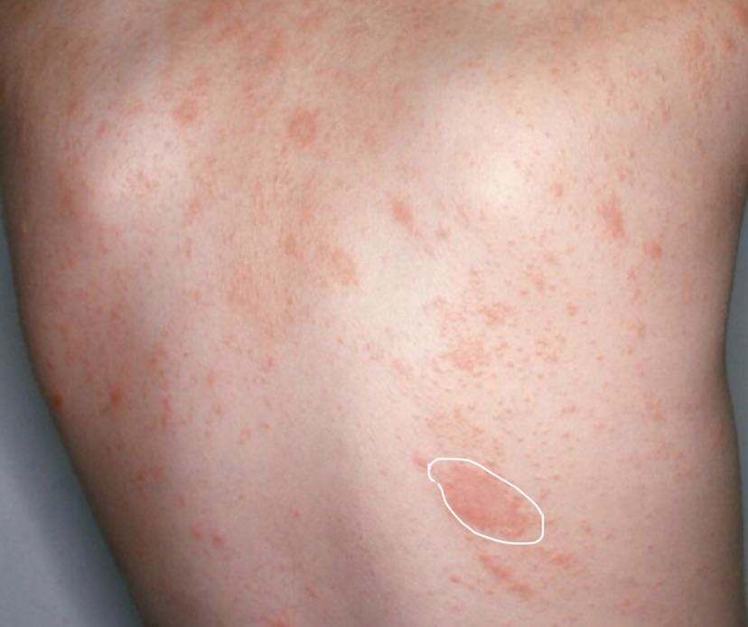 玫瑰糠疹图 玫瑰糠疹图