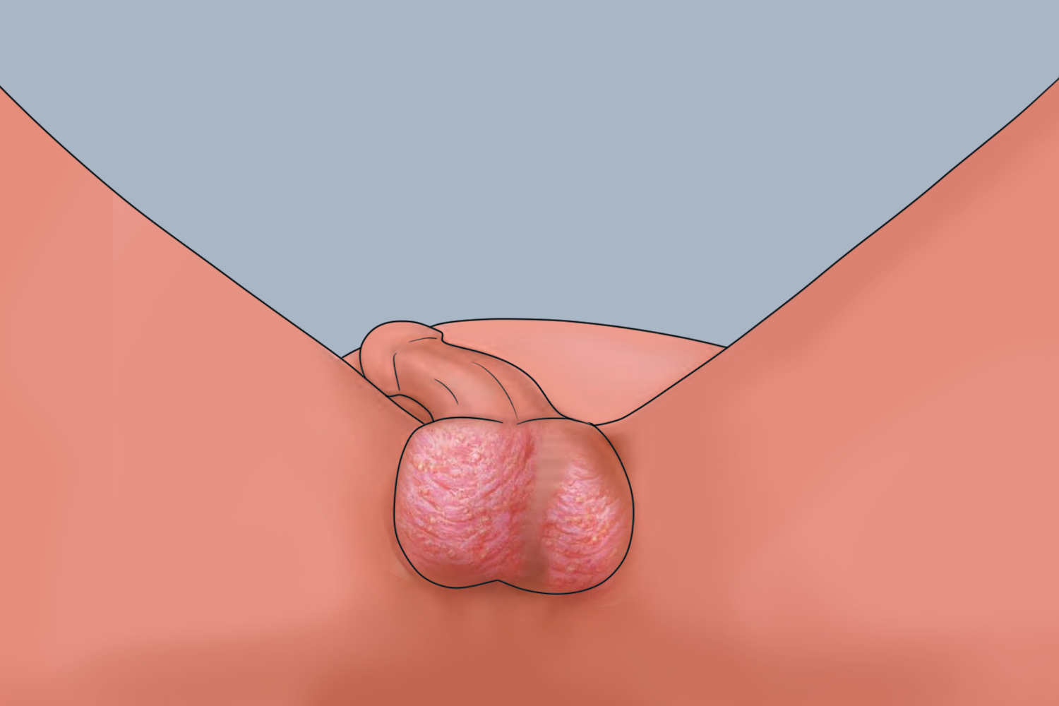 阴囊接触性皮炎图