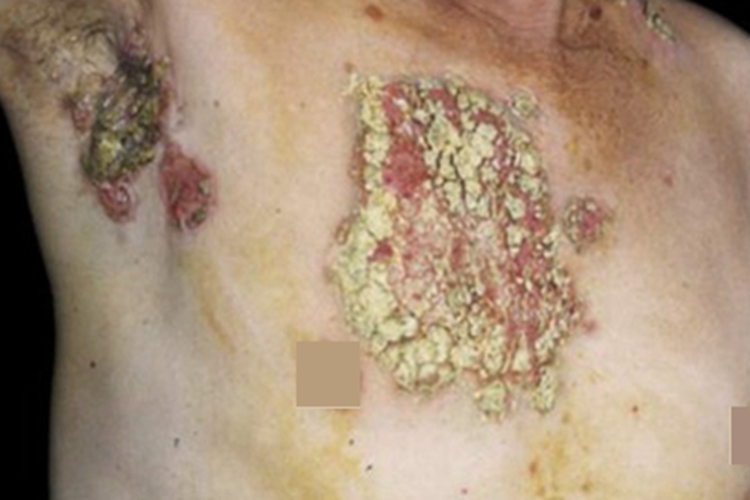 增殖性皮炎胸部症状图 增殖性皮炎胸部症状图