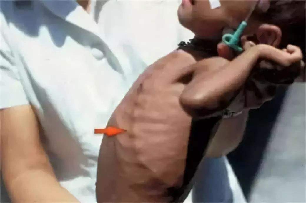 一岁宝宝佝偻病图 一岁宝宝佝偻病图