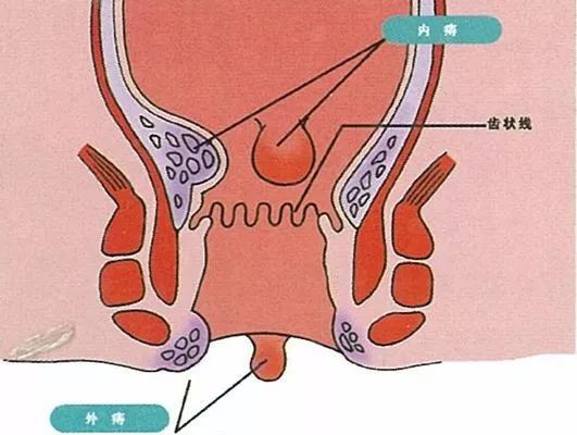 女性肛门外痔初期图片图片