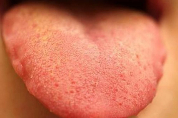 肝火舌苔发黄图