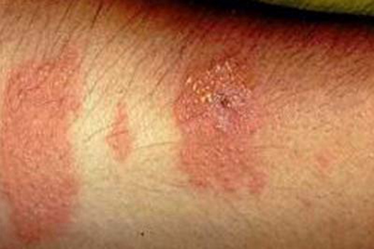 血吸虫尾蚴皮炎胳膊红斑图