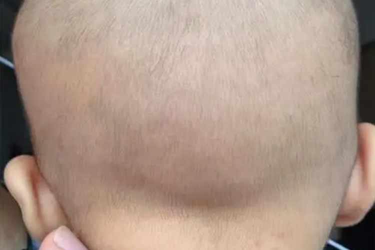 后囟门鼓起来图