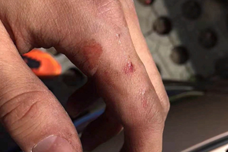 戳伤手指出血图 戳伤手指出血图