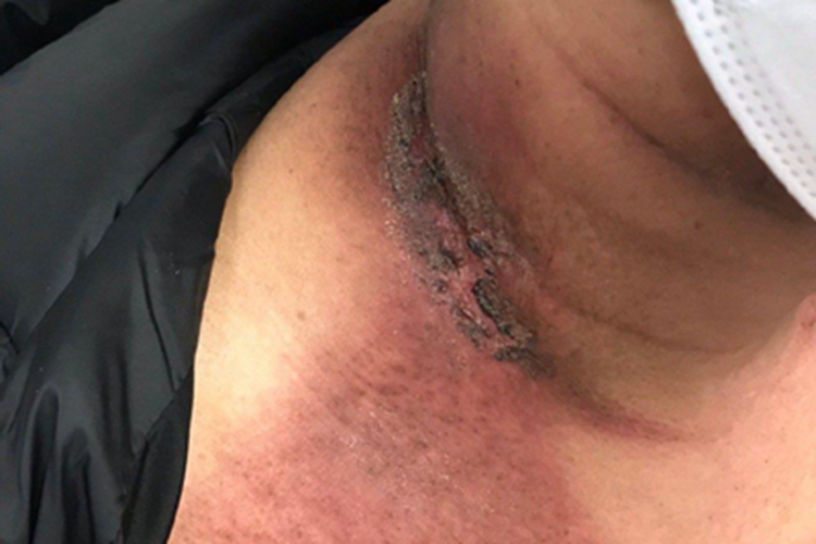 急性放射性皮炎颈部黑痂图 急性放射性皮炎颈部黑痂图