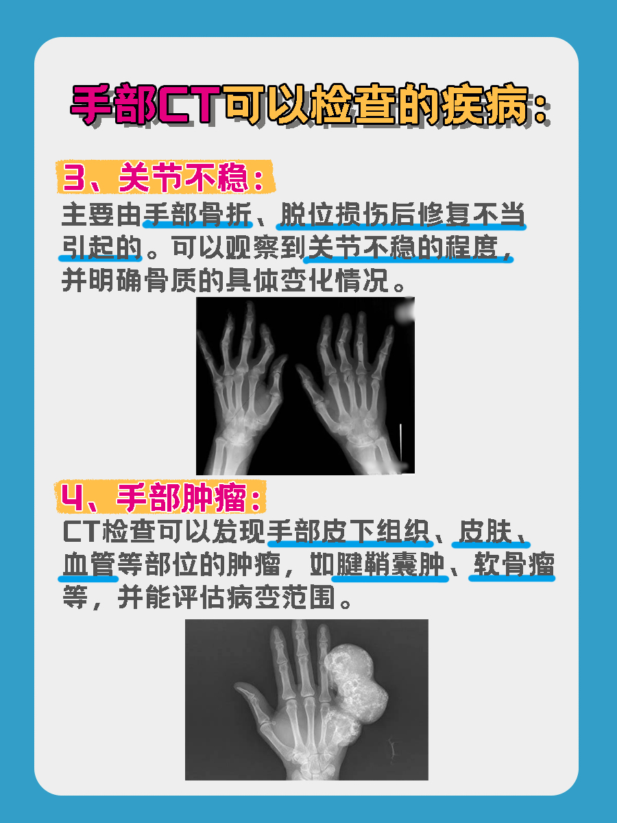 手部CT费用大揭秘，别再被“忽悠‘’了！