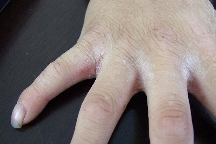 结痂性疥疮手指缝脱屑图 结痂性疥疮手指缝脱屑图