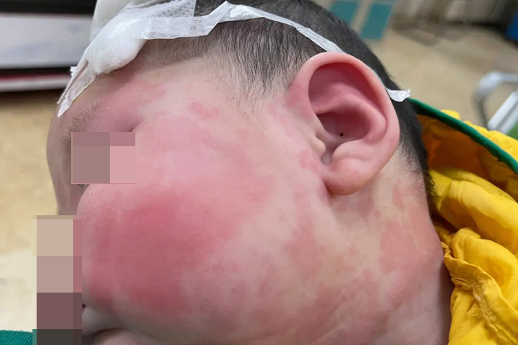 奶粉过敏风团图 奶粉过敏风团图