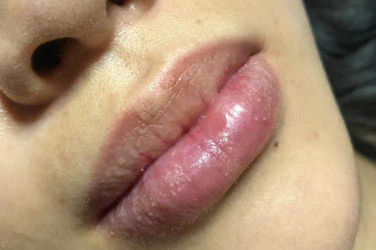 迷脂症嘴唇症状图