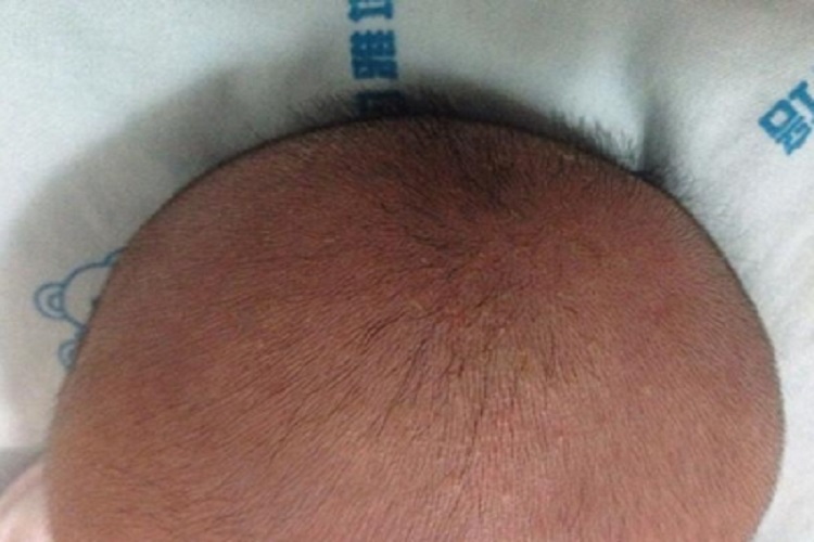 小儿生长激素缺乏症头发稀疏图 小儿生长激素缺乏症头发稀疏图