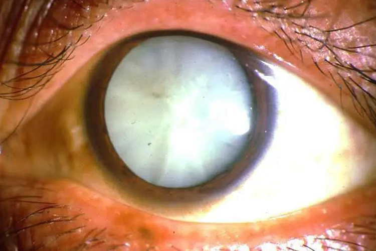 皮质性白内障成熟期图