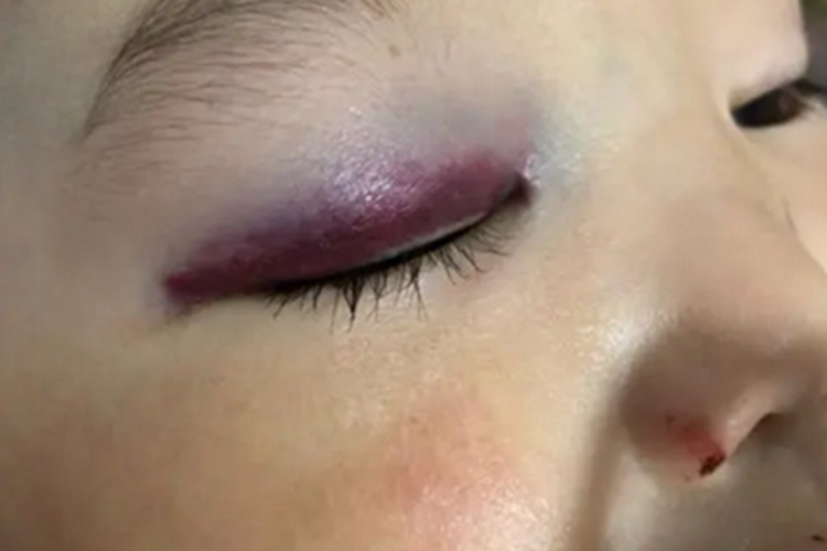 眼眶血肿眼睑症状图 眼眶血肿眼睑症状图