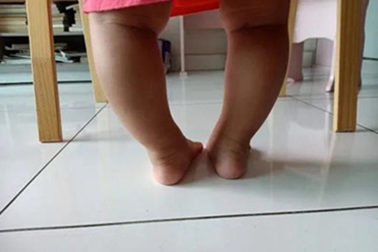 维生素D缺乏性佝偻病症状图 维生素D缺乏性佝偻病症状图