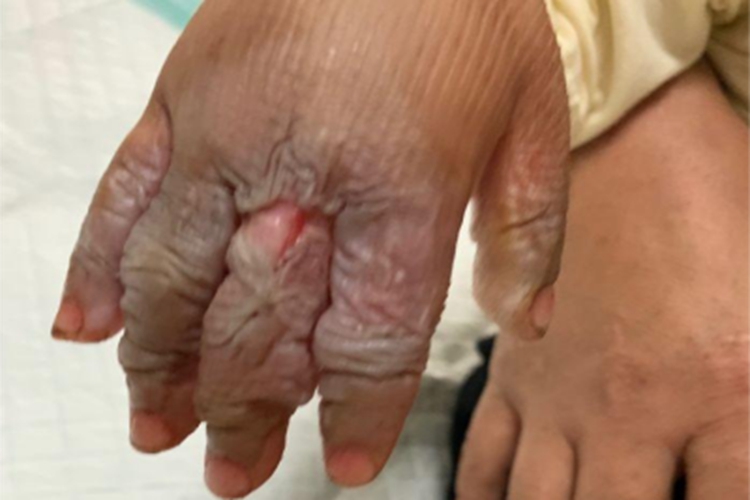 烫伤手指脱皮图