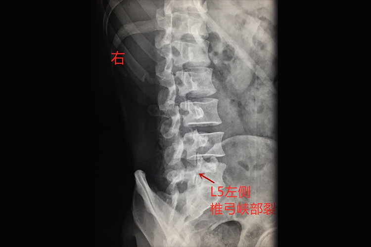 腰5椎弓峡部裂图