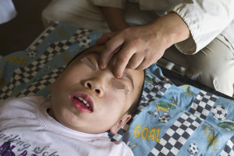 黏多糖贮积症面容图 黏多糖贮积症面容图