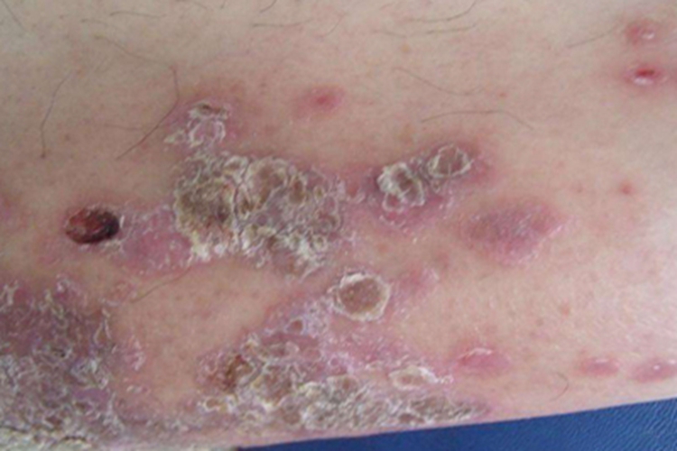 扁平苔藓小腿紫斑结痂图