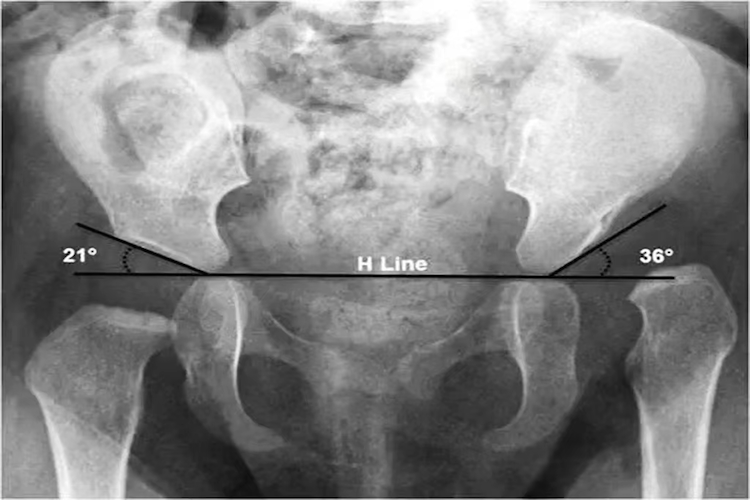 髋关节脱位X线图