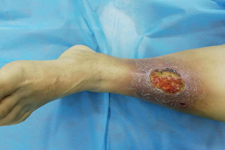 腿部压疮图 腿部压疮图