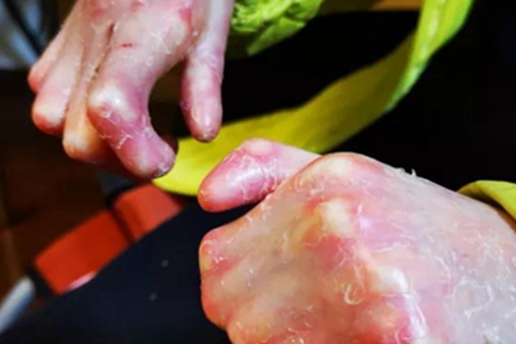 交界型大疱性表皮松解症图 交界型大疱性表皮松解症图