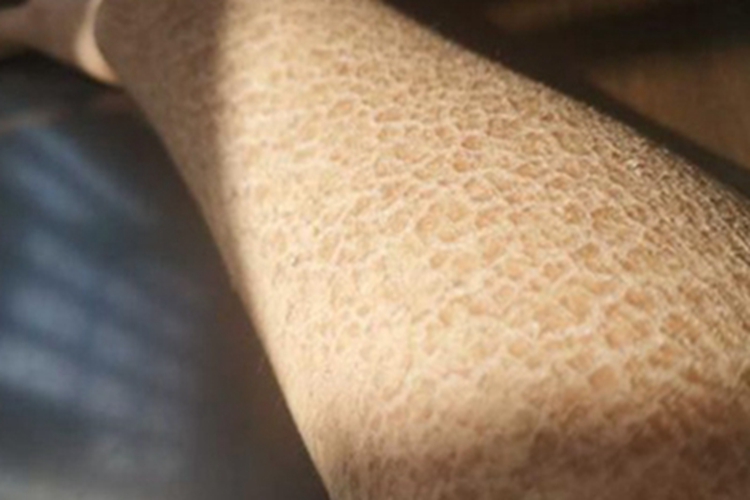 毛囊性鱼鳞病胳膊脱屑图