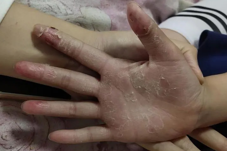 手足口病恢复期手部脱皮图 手足口病恢复期手部脱皮图