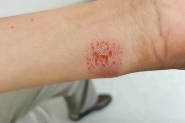 亚急性湿疹手腕症状图