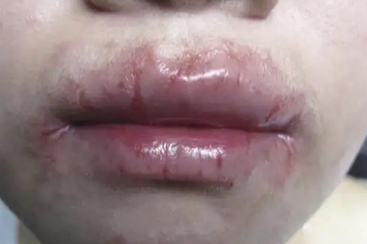 浆细胞性唇炎图