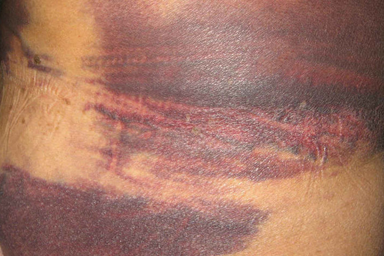 广泛瘀斑图 广泛瘀斑图