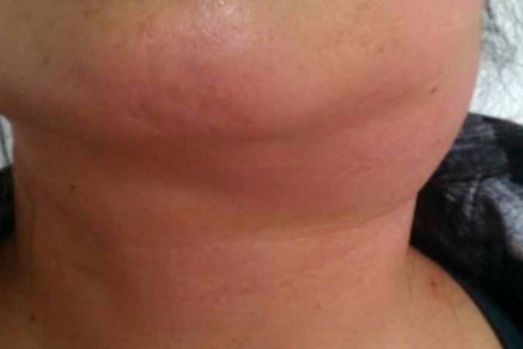 鼻咽癌颈部肿块图 鼻咽癌颈部肿块图