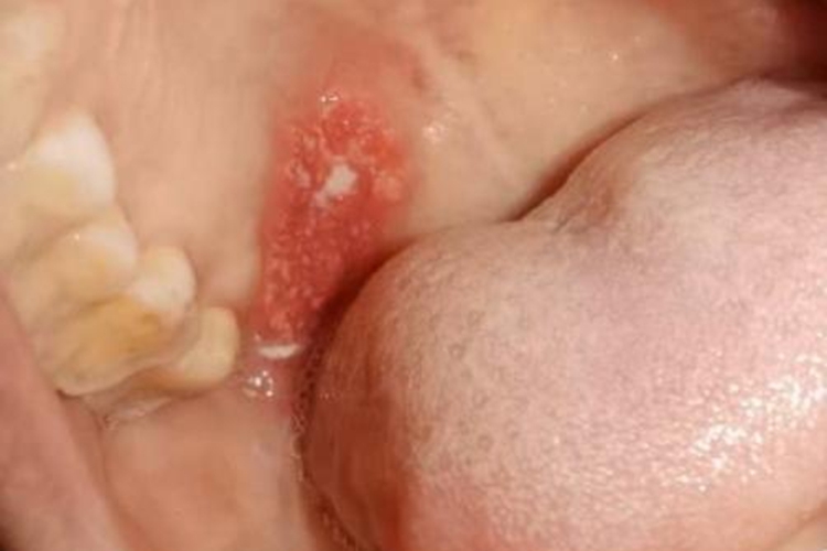 口腔红斑病上腭红点图