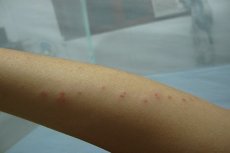 皮疹线状排列图