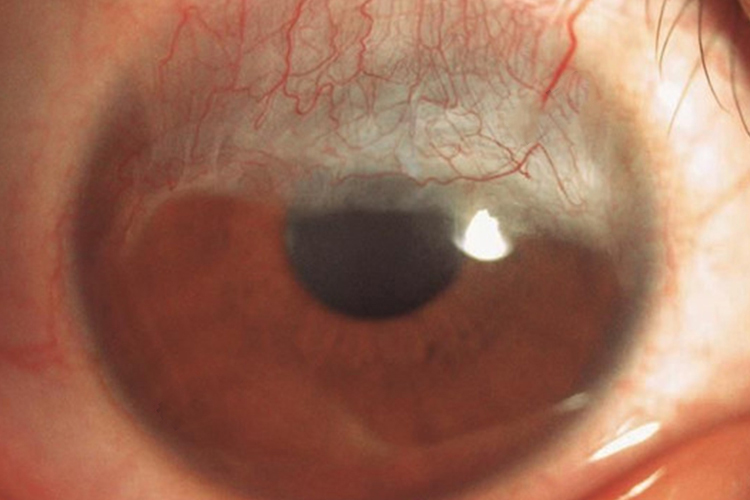 角膜新生血管早期图 角膜新生血管早期图