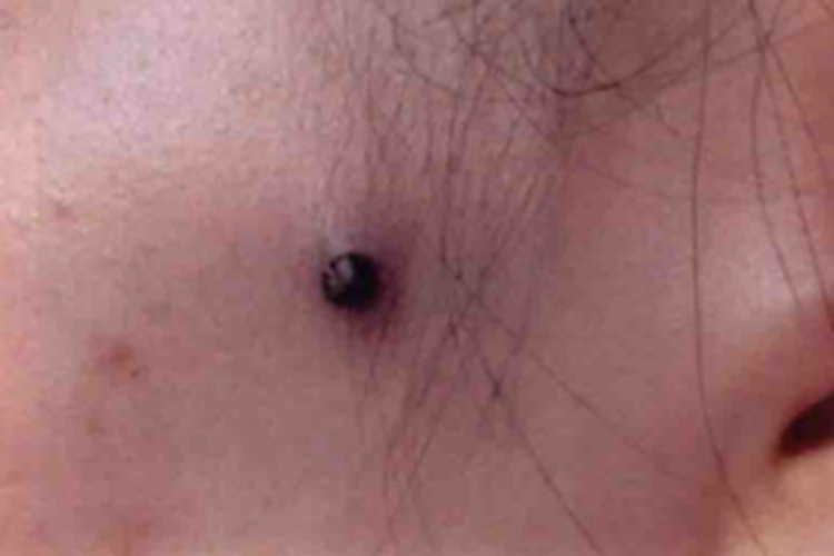 良性幼年黑素瘤面部长黑色结节图
