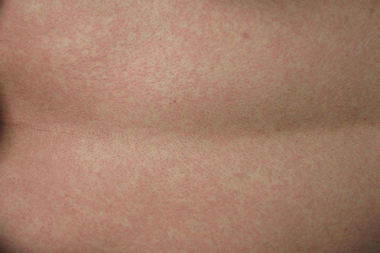 皮排导致麻疹样皮损图