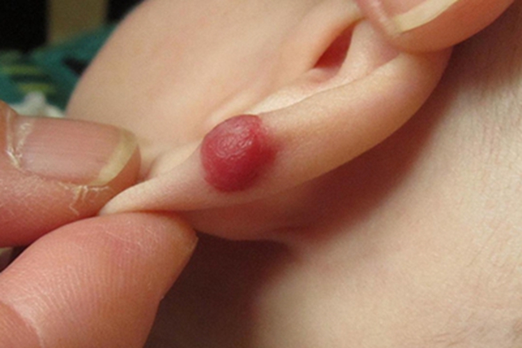 毛细血管瘤耳廓症状图 毛细血管瘤耳廓症状图