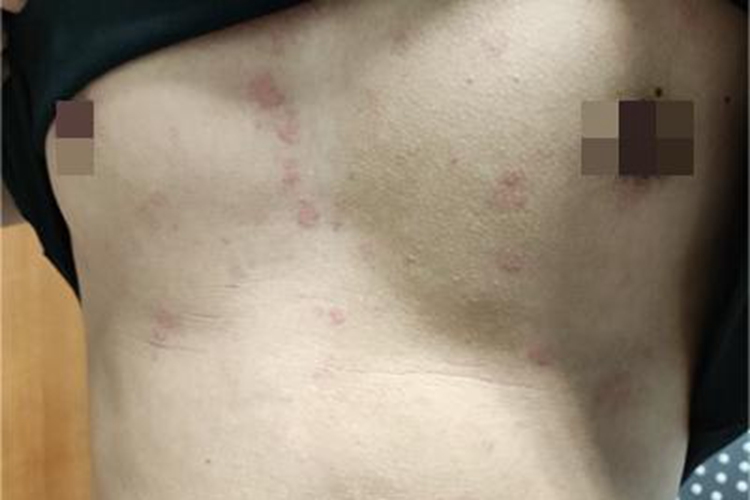急性自发性荨麻疹胸部红斑图