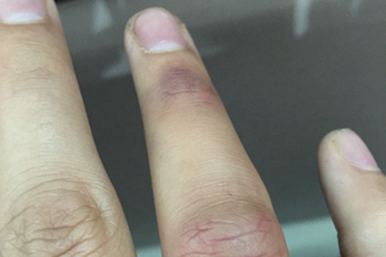 轻度扭伤手部症状图