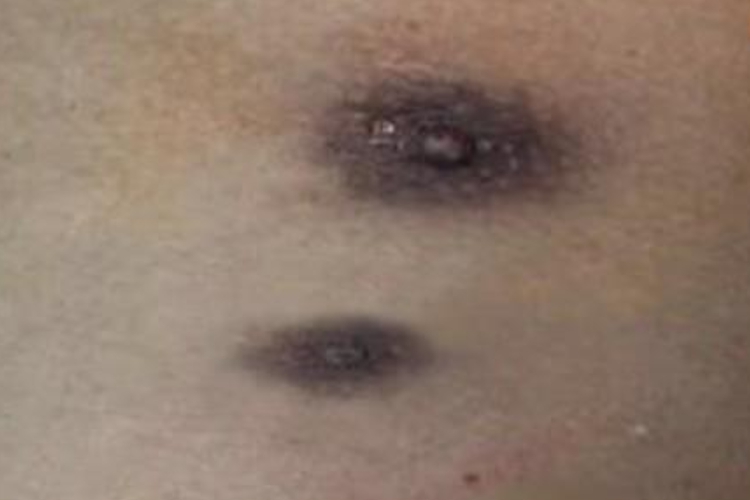 男性副乳两个乳头图