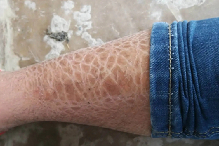 板层状鱼鳞病小腿症状图 板层状鱼鳞病小腿症状图