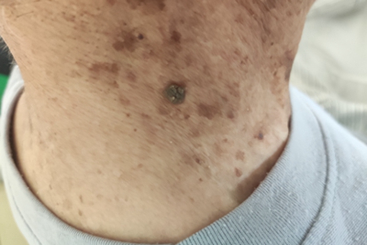 脂溢性角化病颈部斑图