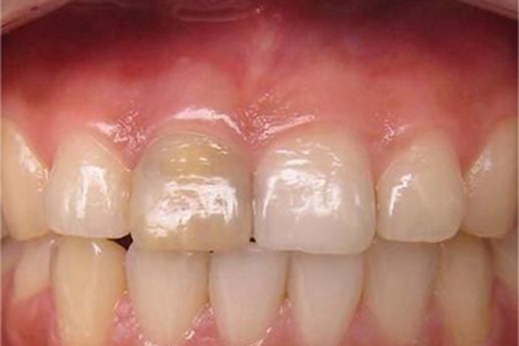 死髓牙牙齿变色图