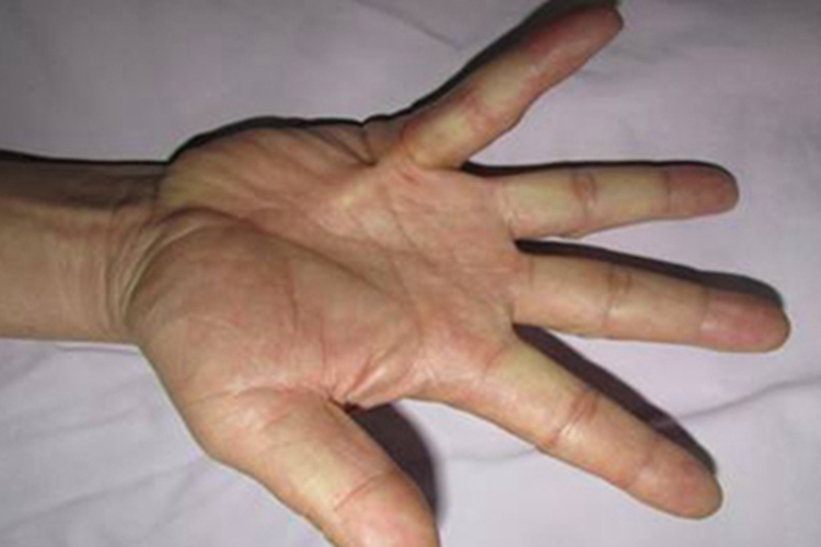 掌腱膜挛缩症手指结节图