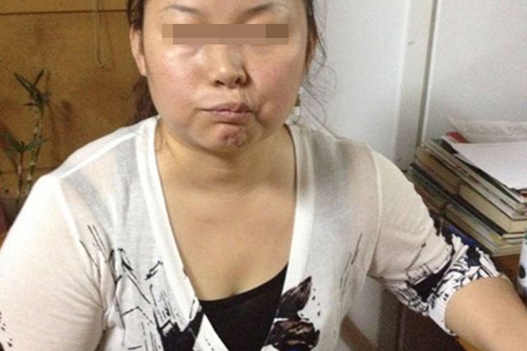 贝尔面瘫嘴角下垂图