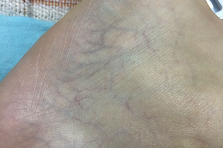 脚踝红血丝图 脚踝红血丝图