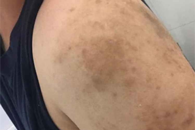 麻疹胳膊长斑图