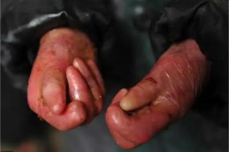 交界型大疱性表皮松解症手褶皱图 交界型大疱性表皮松解症手褶皱图